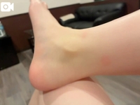 私の白肌によくも⋯