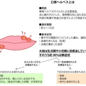 口唇ヘルペス