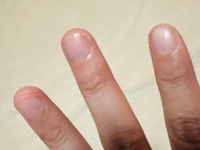 治ったァァァ⤴︎ ⤴︎